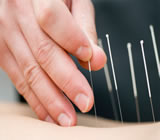 acupuntura-no-Saúde